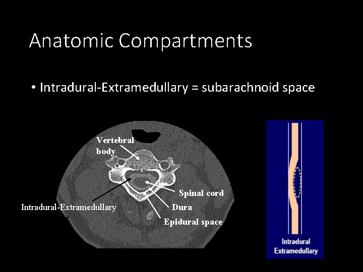 Anatomic Compartments • Intradural-Extramedullary = subarachnoid space Vertebral body Spinal cord Intradural-Extramedullary compartment Dura
