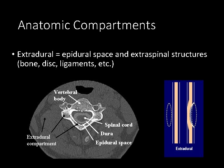 Anatomic Compartments • Extradural = epidural space and extraspinal structures (bone, disc, ligaments, etc.