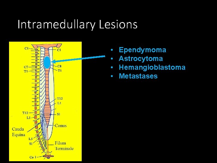Intramedullary Lesions • • Ependymoma Astrocytoma Hemangioblastoma Metastases 