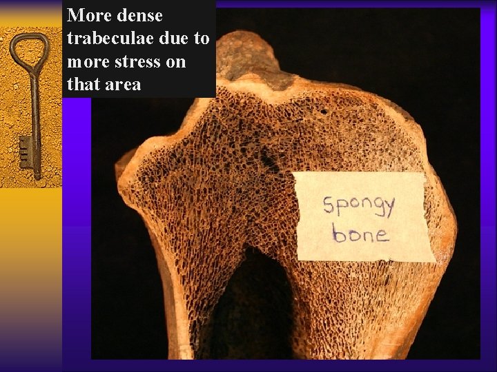 More dense trabeculae due to more stress on that area 