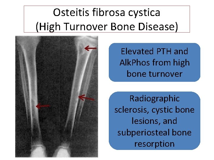 Osteitis fibrosa cystica (High Turnover Bone Disease) Elevated PTH and Alk. Phos from high