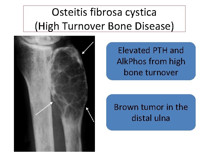 Osteitis fibrosa cystica (High Turnover Bone Disease) Elevated PTH and Alk. Phos from high