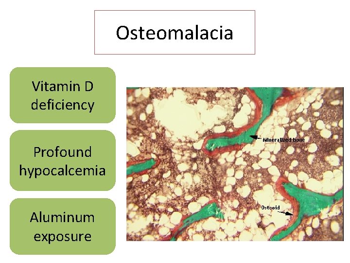 Osteomalacia Vitamin D deficiency Profound hypocalcemia Aluminum exposure 