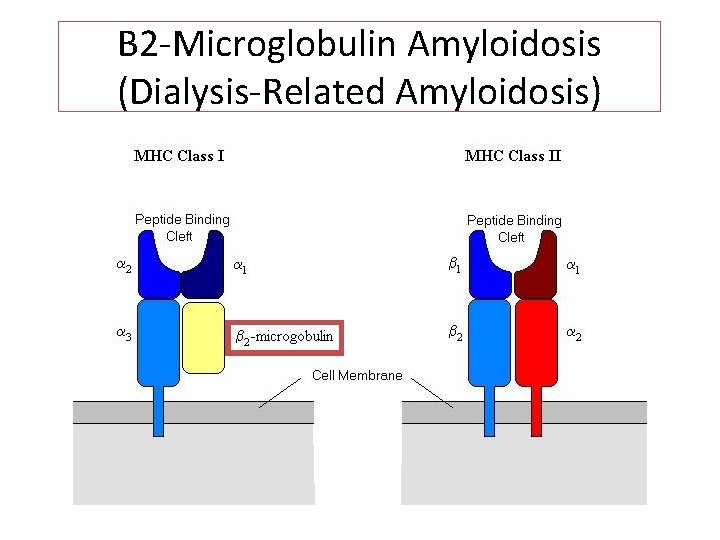 B 2 -Microglobulin Amyloidosis (Dialysis-Related Amyloidosis) 