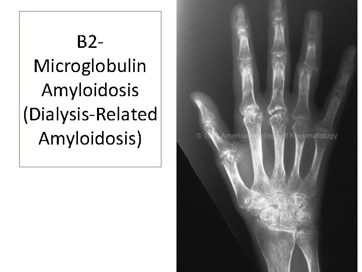 B 2 Microglobulin Amyloidosis (Dialysis-Related Amyloidosis) 