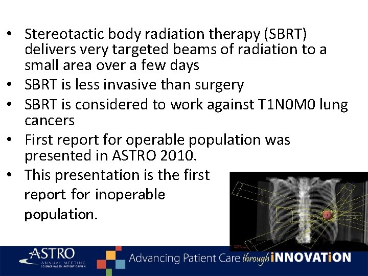  • Stereotactic body radiation therapy (SBRT) delivers very targeted beams of radiation to