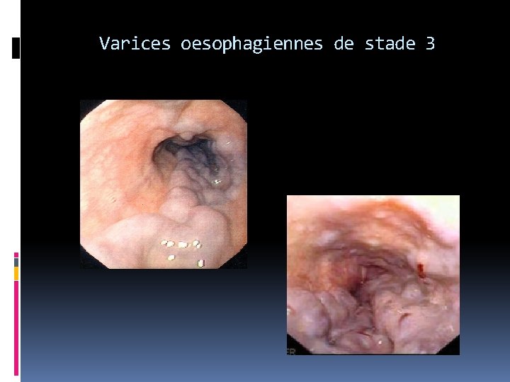 Varices oesophagiennes de stade 3 