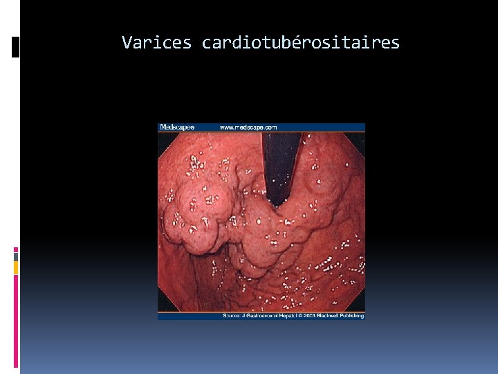 Varices cardiotubérositaires 