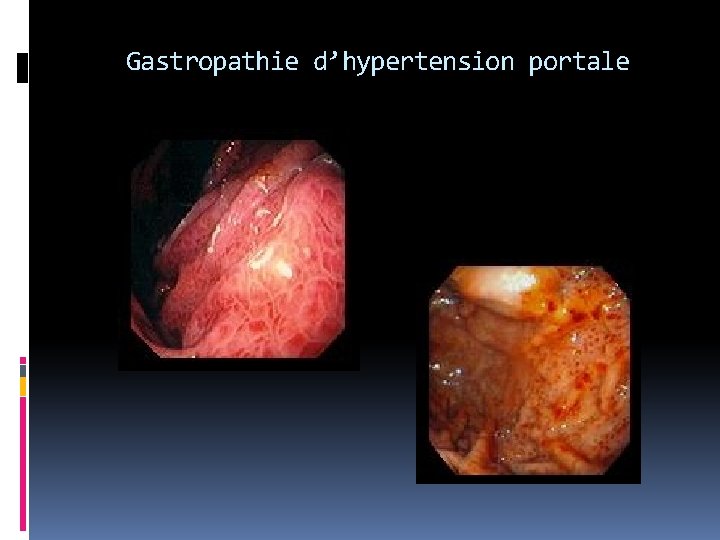 Gastropathie d’hypertension portale 