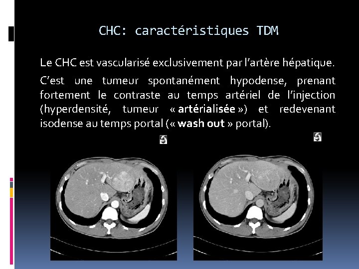 CHC: caractéristiques TDM Le CHC est vascularisé exclusivement par l’artère hépatique. C’est une tumeur