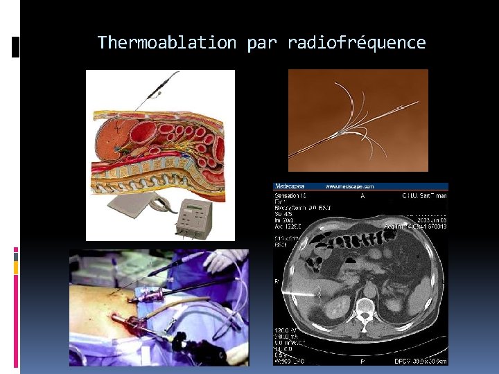 Thermoablation par radiofréquence 