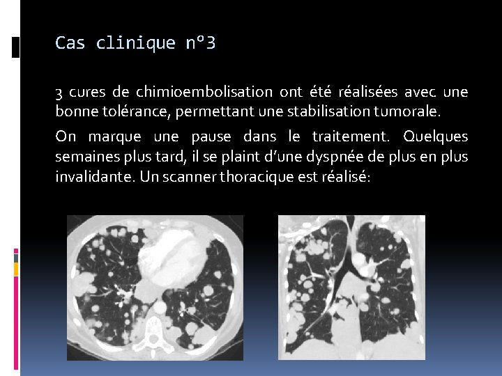 Cas clinique n° 3 3 cures de chimioembolisation ont été réalisées avec une bonne