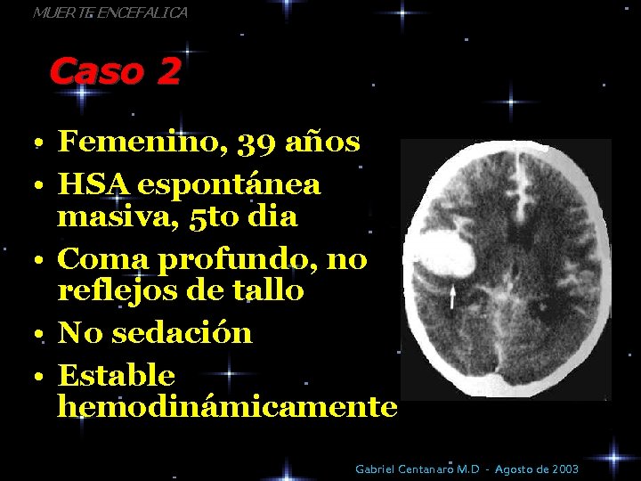 MUERTE ENCEFALICA Caso 2 • Femenino, 39 años • HSA espontánea masiva, 5 to