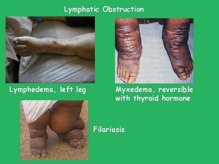 Lymphatic Obstruction Lymphedema, left leg Myxedema, reversible with thyroid hormone Filariasis Lymphatic Obstruction Lymphedema, left leg Myxedema, reversible with thyroid hormone Filariasis