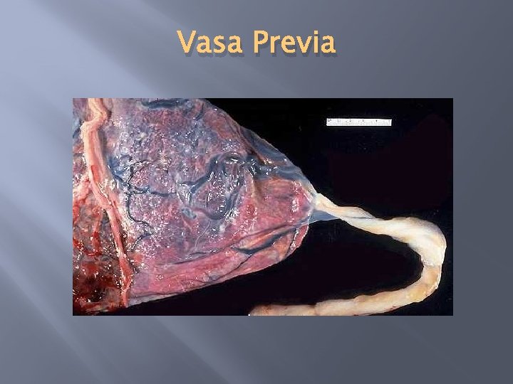 Vasa Previa 