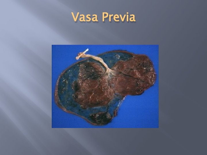 Vasa Previa 