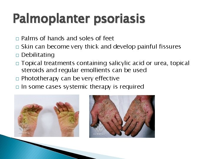 Palmoplanter psoriasis � � � Palms of hands and soles of feet Skin can