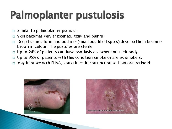 Palmoplanter pustulosis � � � Similar to palmoplanter psoriasis Skin becomes very thickened, itchy