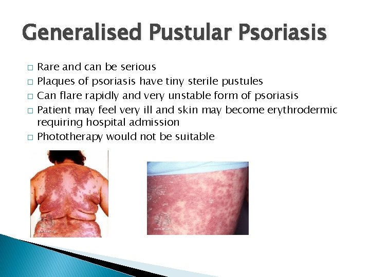 Generalised Pustular Psoriasis � � � Rare and can be serious Plaques of psoriasis
