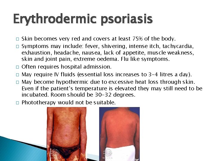 Erythrodermic psoriasis � � � Skin becomes very red and covers at least 75%
