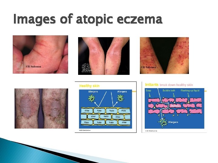 Images of atopic eczema 