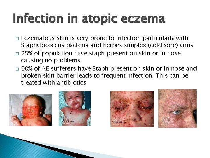 Infection in atopic eczema � � � Eczematous skin is very prone to infection