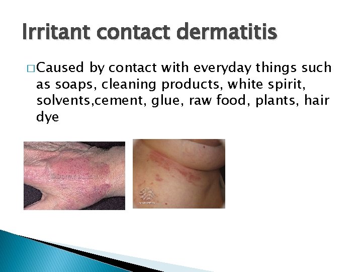 Irritant contact dermatitis � Caused by contact with everyday things such as soaps, cleaning