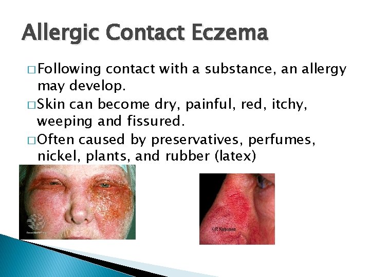 Allergic Contact Eczema � Following contact with a substance, an allergy may develop. �