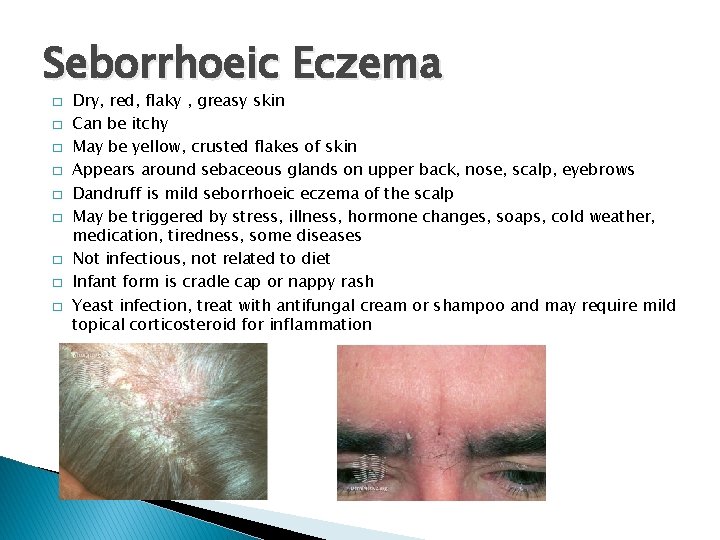 Seborrhoeic Eczema � � � � � Dry, red, flaky , greasy skin Can