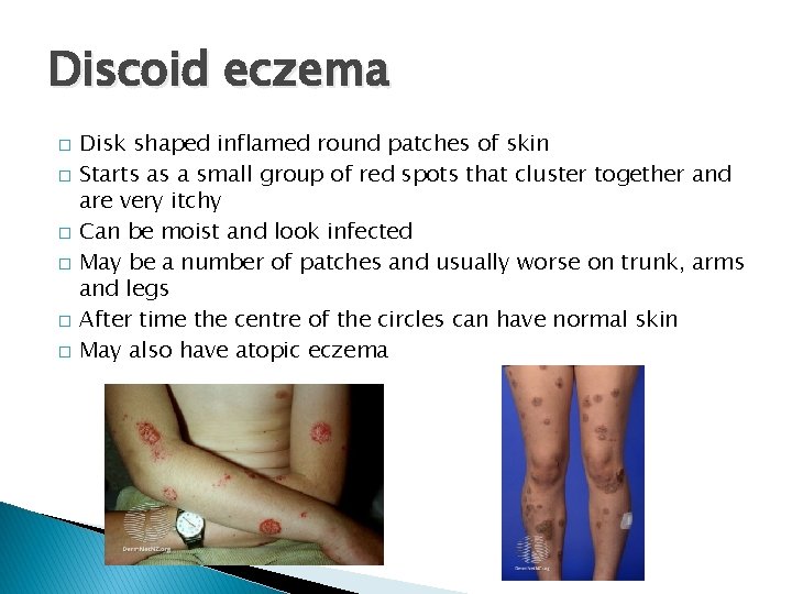 Discoid eczema � � � Disk shaped inflamed round patches of skin Starts as