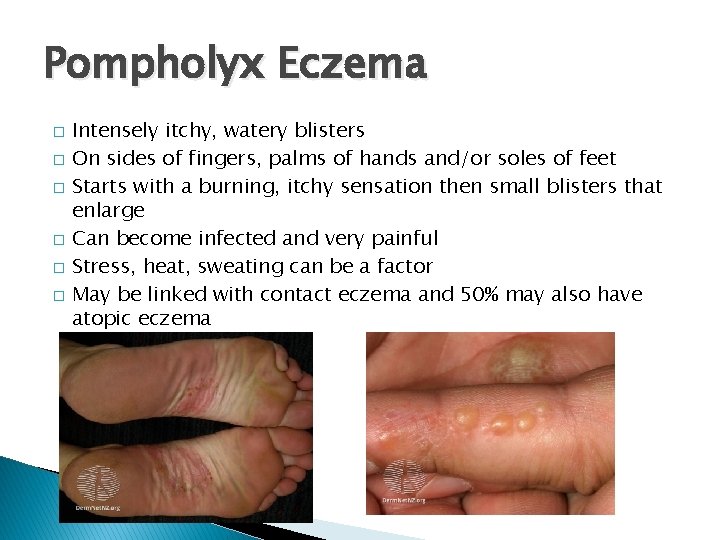 Pompholyx Eczema � � � Intensely itchy, watery blisters On sides of fingers, palms