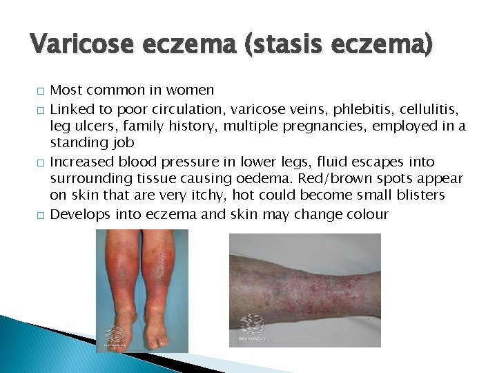 Varicose eczema (stasis eczema) � � Most common in women Linked to poor circulation,