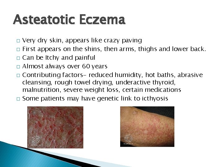 Asteatotic Eczema � � � Very dry skin, appears like crazy paving First appears
