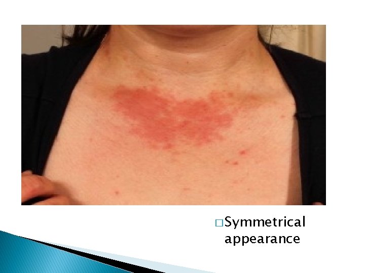 � Symmetrical appearance 
