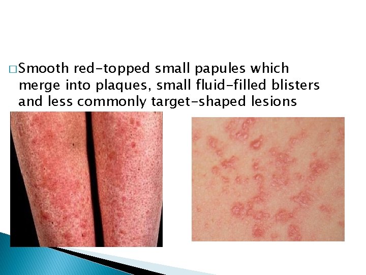 � Smooth red-topped small papules which merge into plaques, small fluid-filled blisters and less