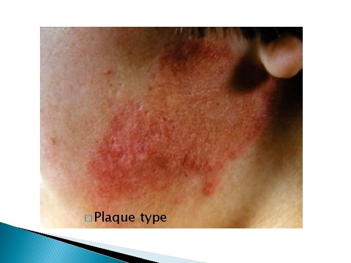� Plaque type 