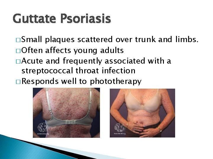 Guttate Psoriasis � Small plaques scattered over trunk and limbs. � Often affects young
