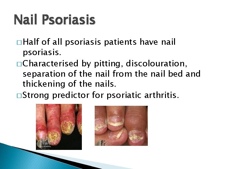 Nail Psoriasis � Half of all psoriasis patients have nail psoriasis. � Characterised by