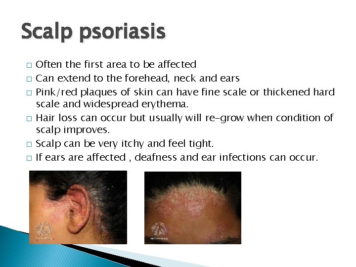 Scalp psoriasis � � � Often the first area to be affected Can extend