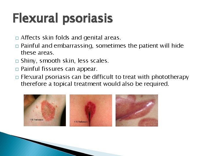 Flexural psoriasis � � � Affects skin folds and genital areas. Painful and embarrassing,