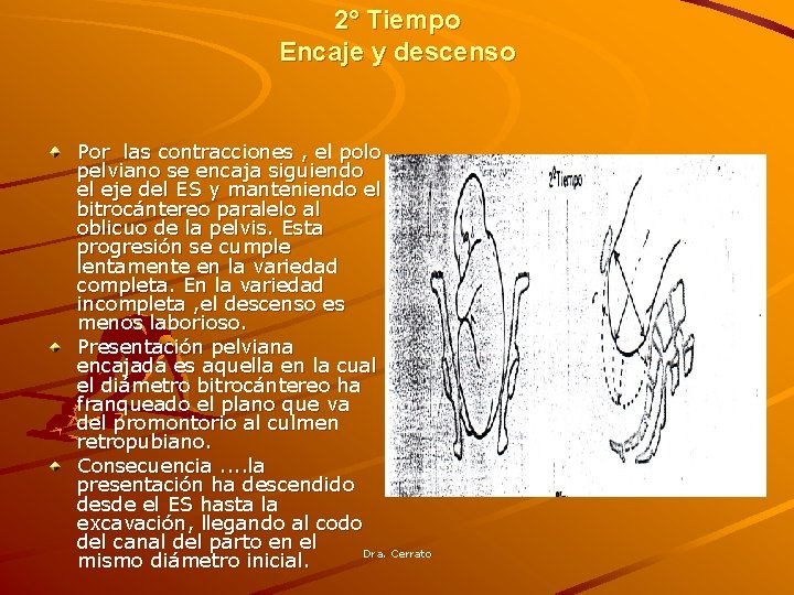 2° Tiempo Encaje y descenso Por las contracciones , el polo pelviano se encaja