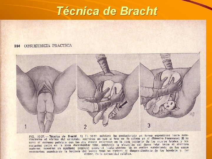 Técnica de Bracht Dra. Cerrato 