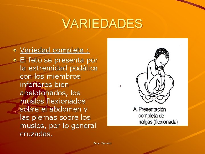 VARIEDADES Variedad completa : El feto se presenta por la extremidad podálica con los