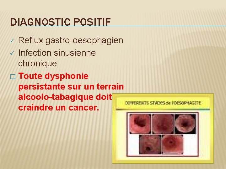DIAGNOSTIC POSITIF Reflux gastro-oesophagien ü Infection sinusienne chronique � Toute dysphonie persistante sur un