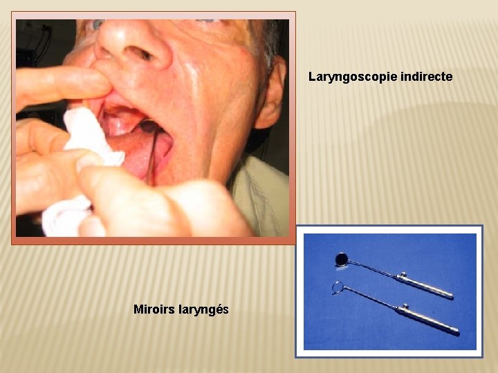 Laryngoscopie indirecte Miroirs laryngés 
