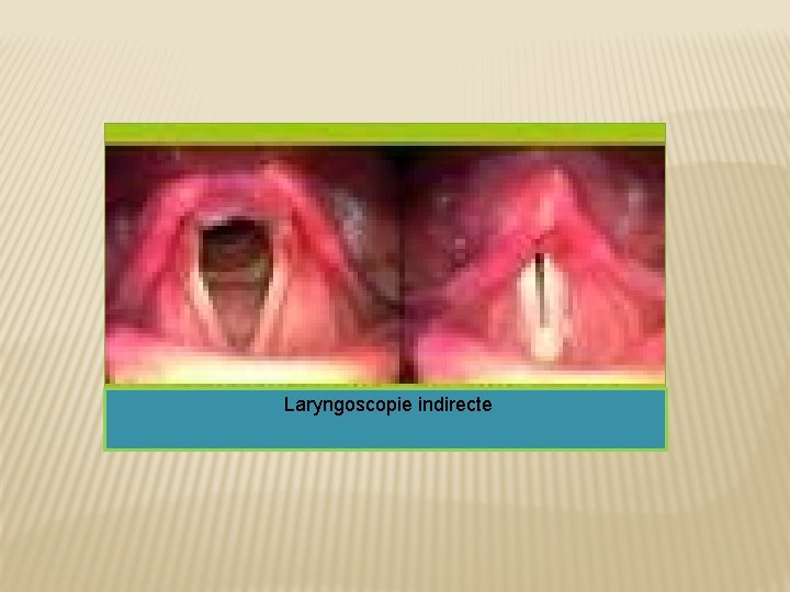 Laryngoscopie indirecte 