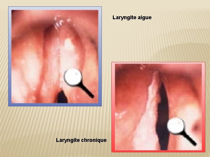 Laryngite aigue Laryngite chronique 