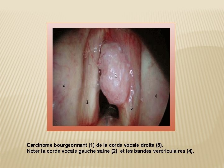 Carcinome bourgeonnant (1) de la corde vocale droite (3). Noter la corde vocale gauche