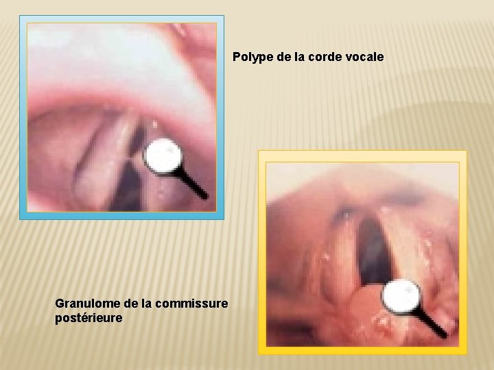 Polype de la corde vocale Granulome de la commissure postérieure 