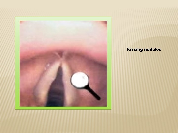 Kissing nodules 